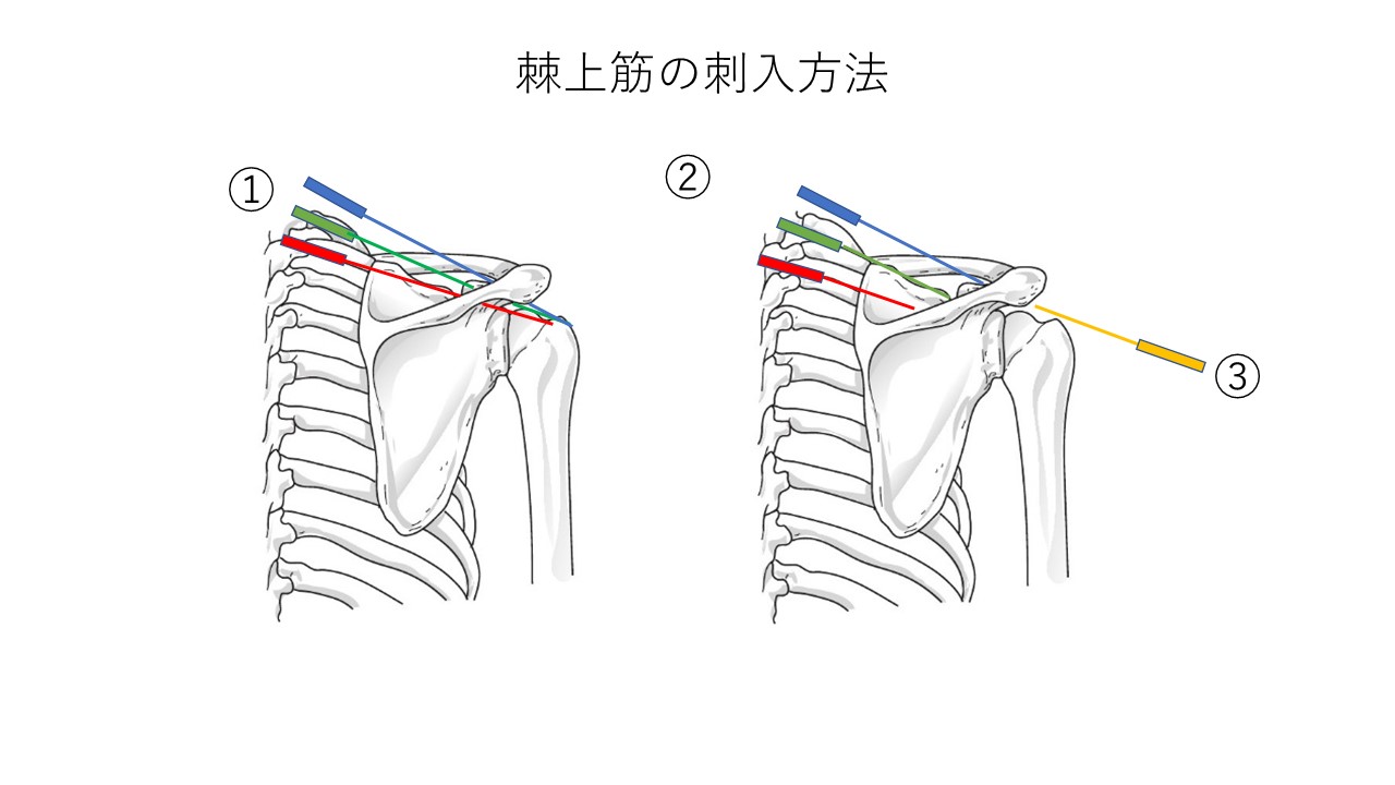 棘上筋の刺入方法1