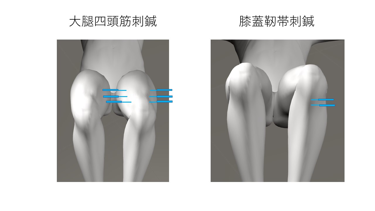 大腿四頭筋、膝蓋靭帯刺鍼部位