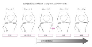 変形性膝関節症分類図