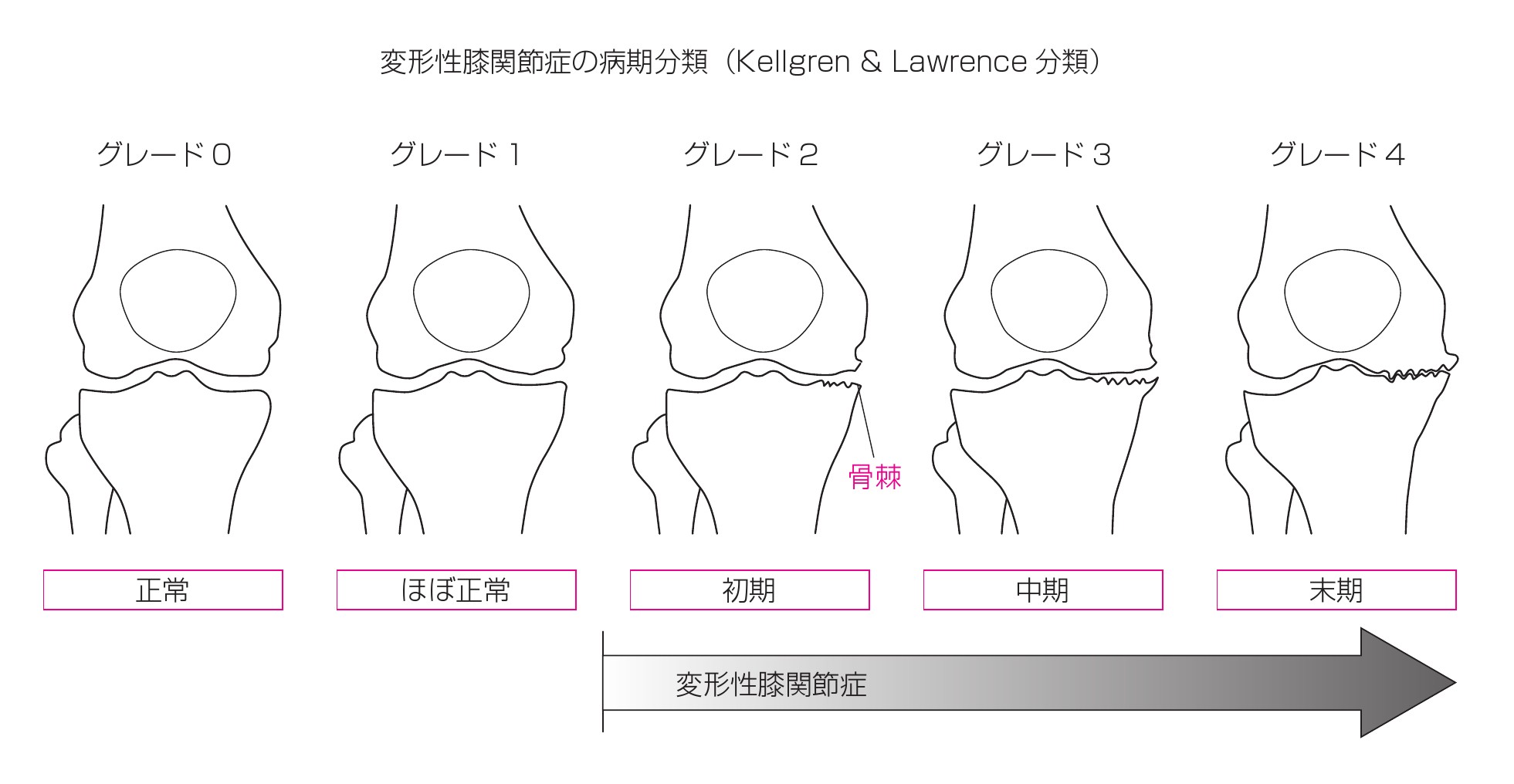 変形性膝関節症分類図