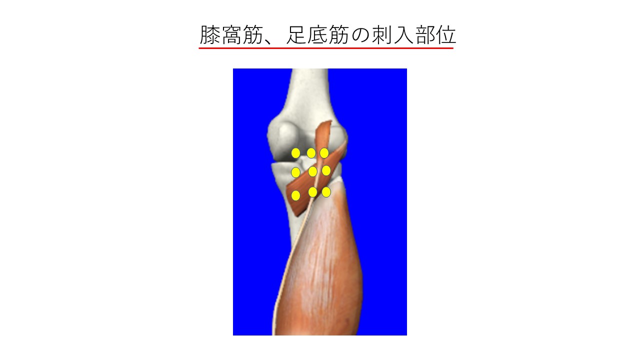 膝窩筋、足底筋の刺入部位
